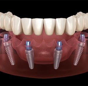 All-on-4 dental implants for lower arch
