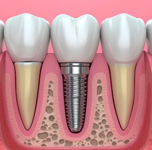 A computer illustration showing a dental implant in a jawbone