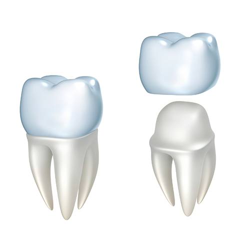 Model showing a dental crown covering a tooth