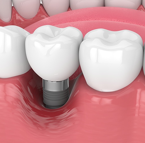 Illustration of damaged gums around failed dental implant