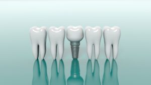 Dental implant and molars on green background